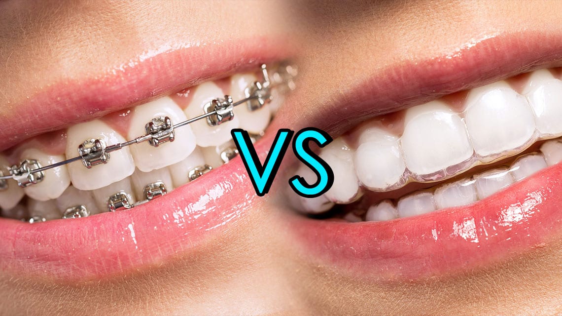 Invisalign Pros and Cons: Could Braces Be a Better Option? – Miosuperhealth