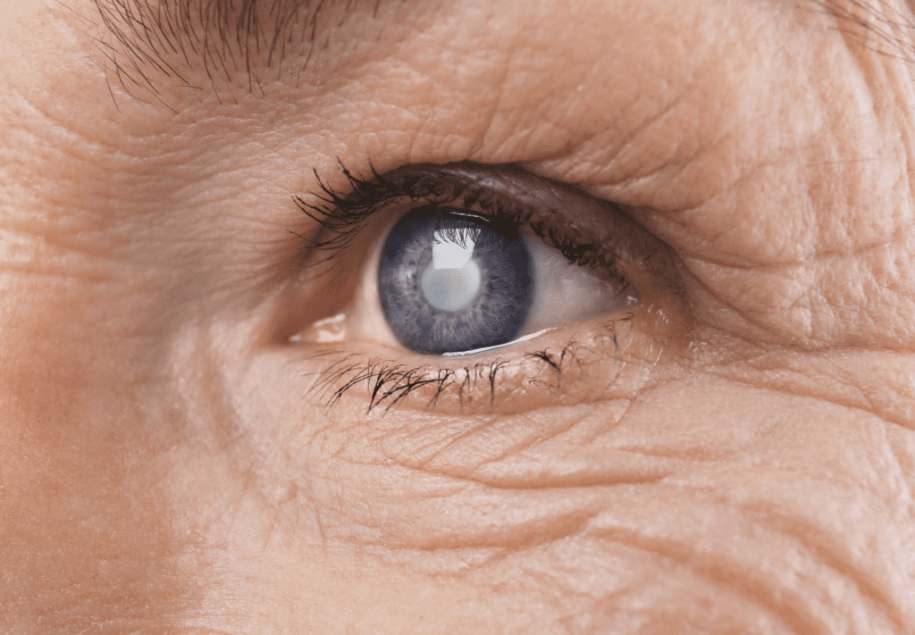 Bulging Eyes, Cataracts, and More A Lowdown of Common Eye Conditions
