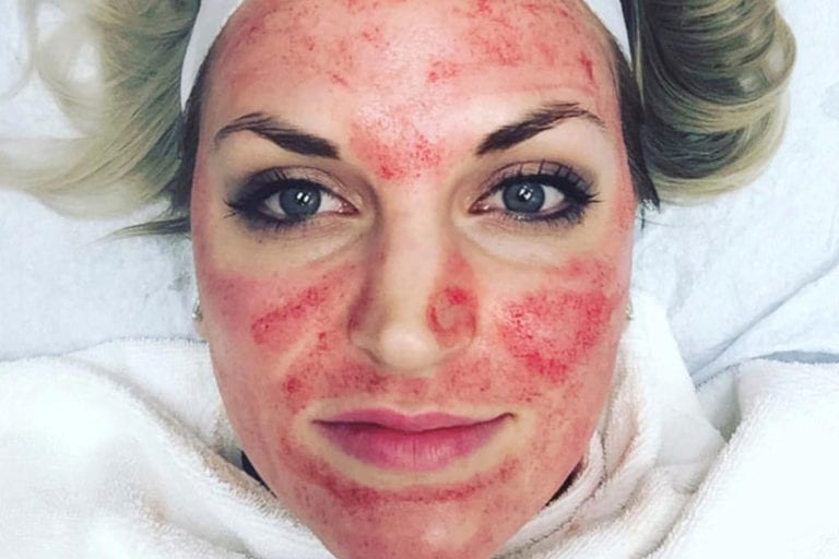 What Is Vampire Facial and Who Can Perform It Miosuperhealth