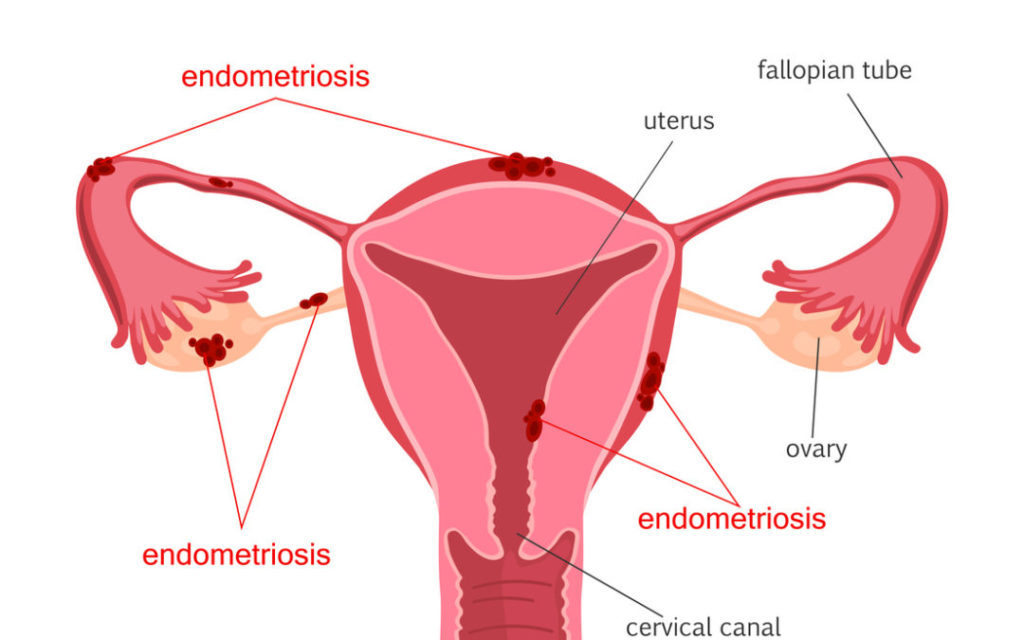 Endometriosis What you Need to Know Miosuperhealth