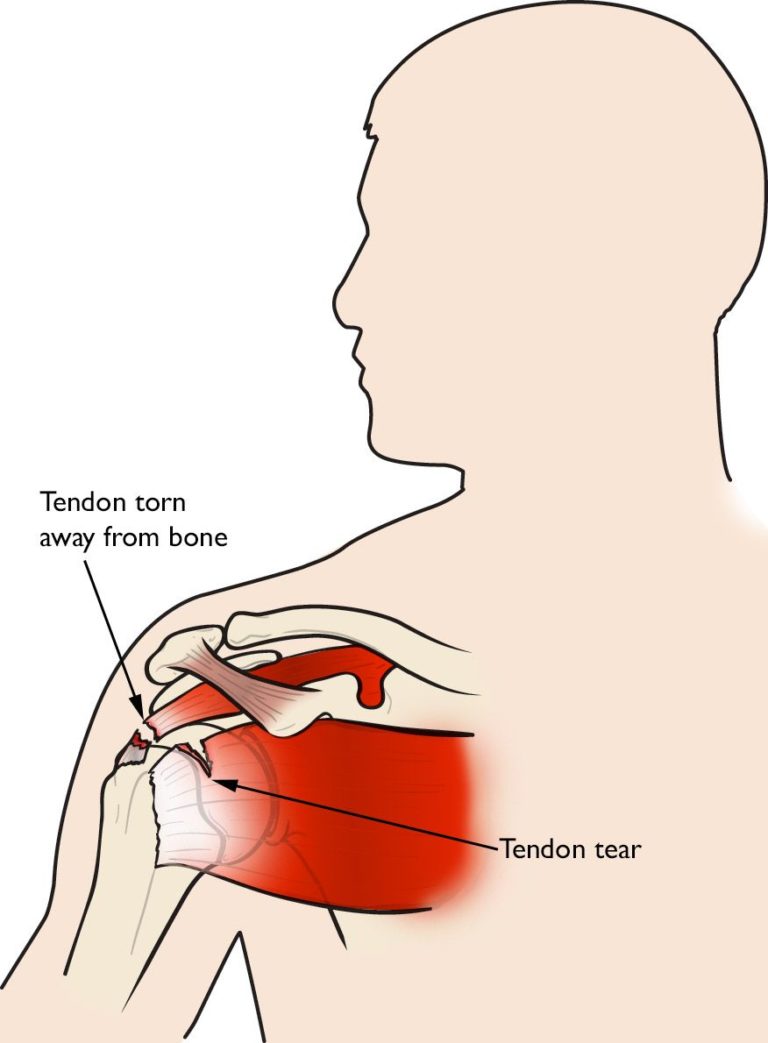 Rotator Cuff Injuries Symptoms And Treatments Miosuperhealth