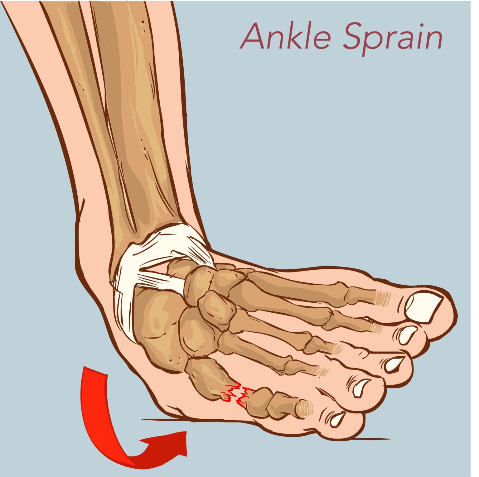 what-to-expect-after-spraining-your-ankle-miosuperhealth