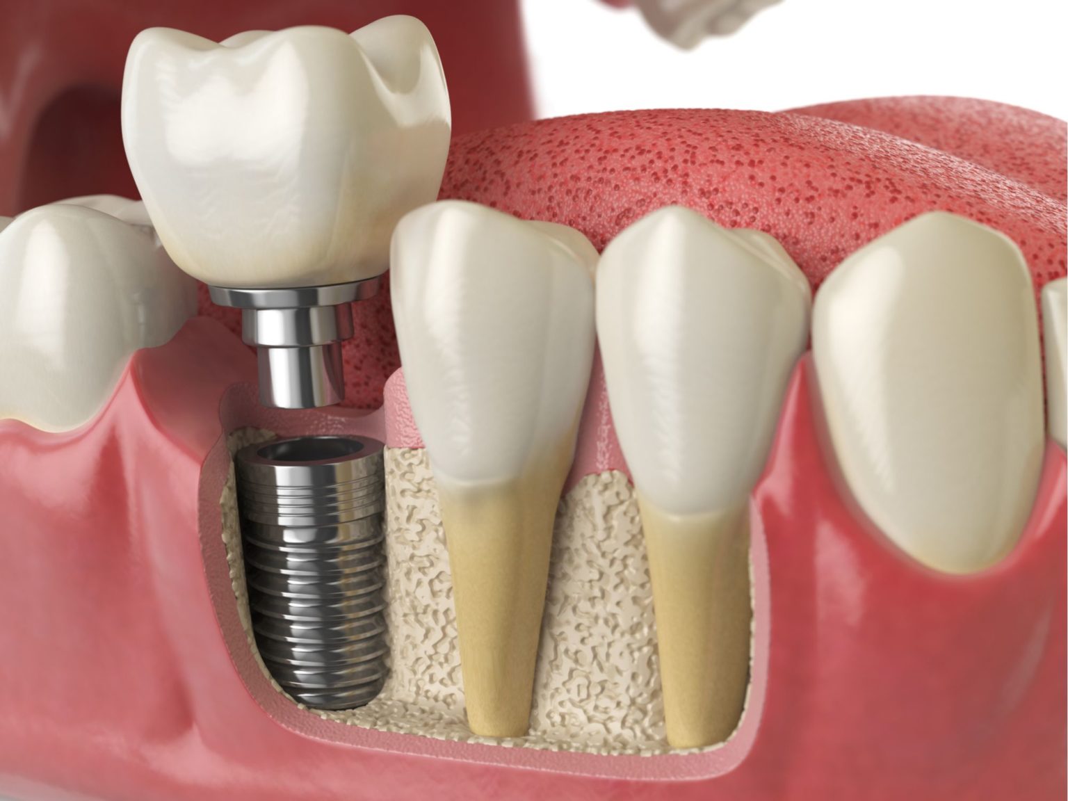 Dental implants Benefits and success rates Miosuperhealth