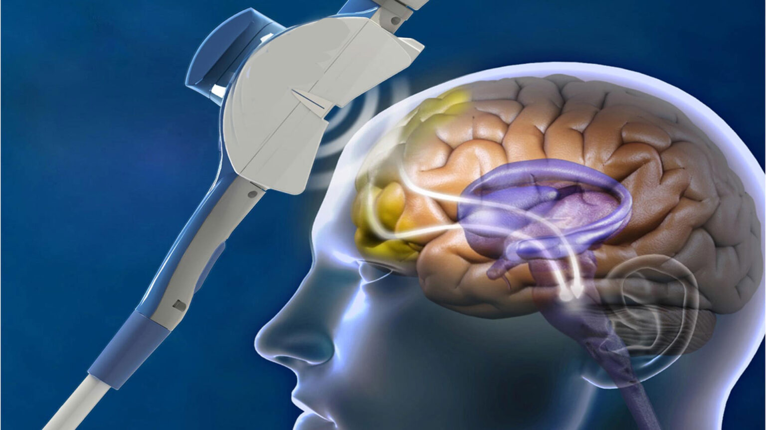 How Effective Is TMS A Brief Look Into TMS Therapy Success 