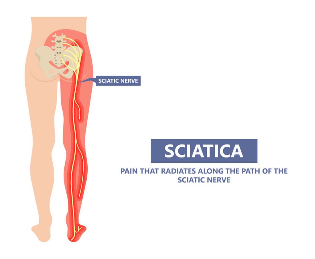 Myths And Facts You Need To Know About Sciatica Miosuperhealth