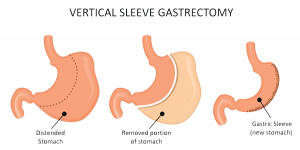 What is bariatric surgery? Learn about the SADI-S procedure ...