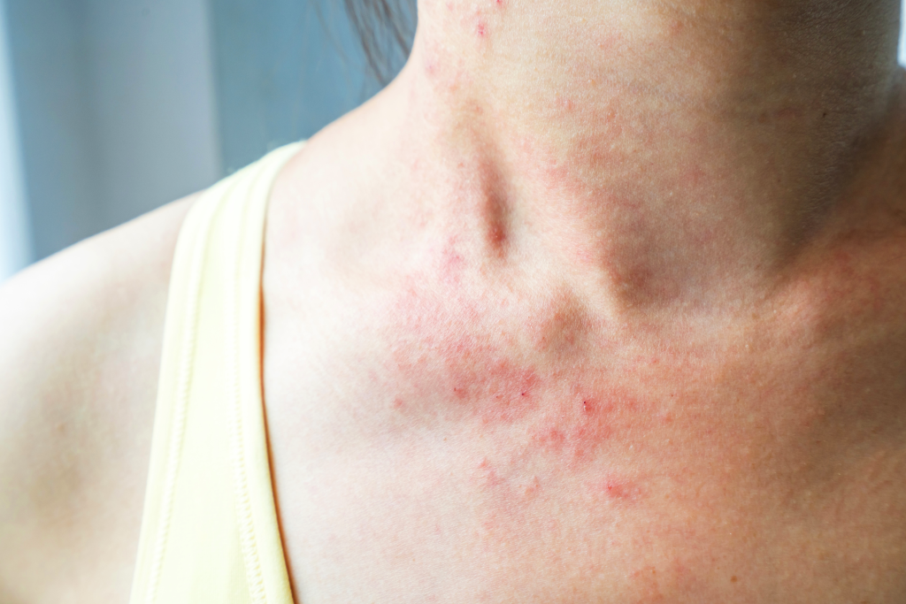 Skin Rashes & Itch-Types, Causes, and Treatments – Miosuperhealth